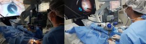 cirurgias de retina e catarata 3d em Curitiba