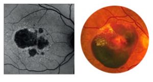 degeneracao macular de retina em curitiba