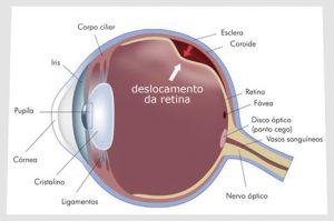 descolamento de retina tratamento em curitiba
