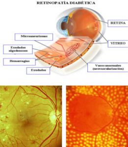 retinopadia diabetica curitiba