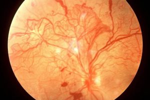 retinopatia diabetica curitiba