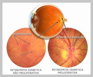 retinopatia diabetica tratamento em curitiba