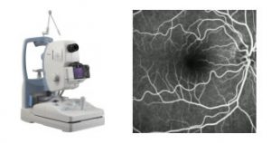 exame de Angiografia Digital de Retina em curitiba