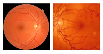 mapeamento de retina em curitiba