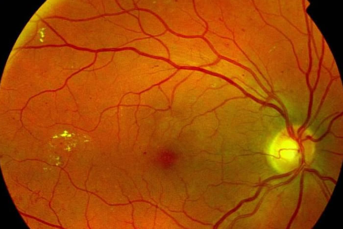retinopatia diabetica causa cegueira