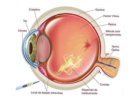 injeção intravitrea para edema macular de retina