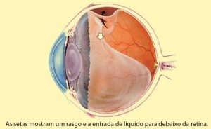 tratamento de descolamento de retina em crianças em curitiba