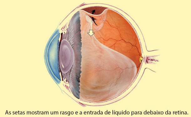 tratamento de descolamento de retina em crianças em curitiba