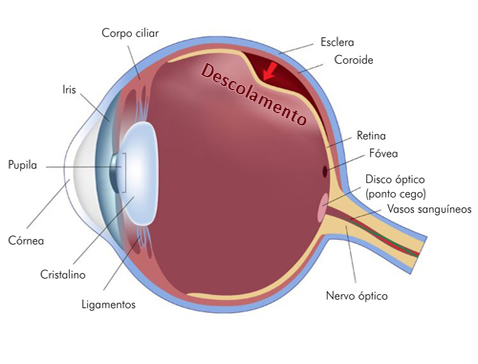 tratamento para descolamento de retina em crianças em curitiba