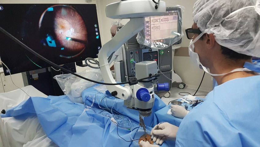 O Dr. Alexandre Grandinetti, especialista em retina e vítreo, passou a utilizar o equipamento NGENUITY®, que permite a visualização 3D com profundidade dos tecidos oculares para cirurgias de Retina e Catarata, facilitando a observação de detalhes importantes do olho e tornando a cirurgia ainda mais segura. Dr. Alexandre relata que o NGENUITY® 3D é um equipamento que está revolucionando a qualidade na imagem, profundidade de campo e a ergonomia para o cirurgião durante o procedimento. Todos esses fatores combinados resultam em uma precisão cirúrgica nunca visto antes na oftalmologia. O médico explica que as cirurgias de retina, antes dos equipamentos com visualização 3D, eram realizadas com uma visão bidimensional, o que dificultava a ação do médico, pois a percepção de profundidade exigia muito conhecimento teórico e prático. Já a visualização 3D proporcionada pelo NGENUITY permite identificar detalhes com muito mais facilidade e clareza. Com essa nova tecnologia, as cirurgias de retina e catarata alcançam mais segurança e melhores resultados.