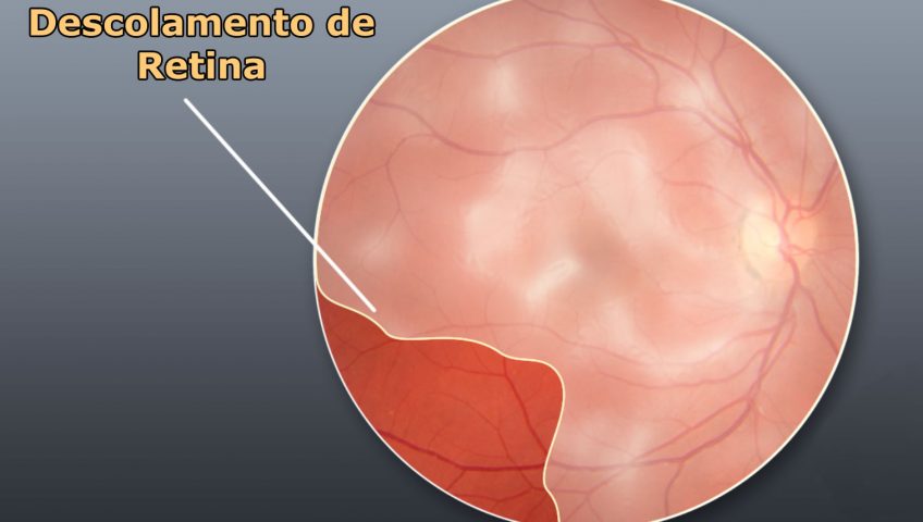 tratamento para descolamento de retina em curitiba
