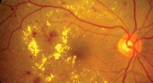 tratamento de retinopatia diabetica especialista em curitiba