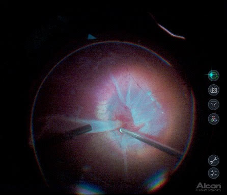 coloboma ocular em curitiba tratamento na retina
