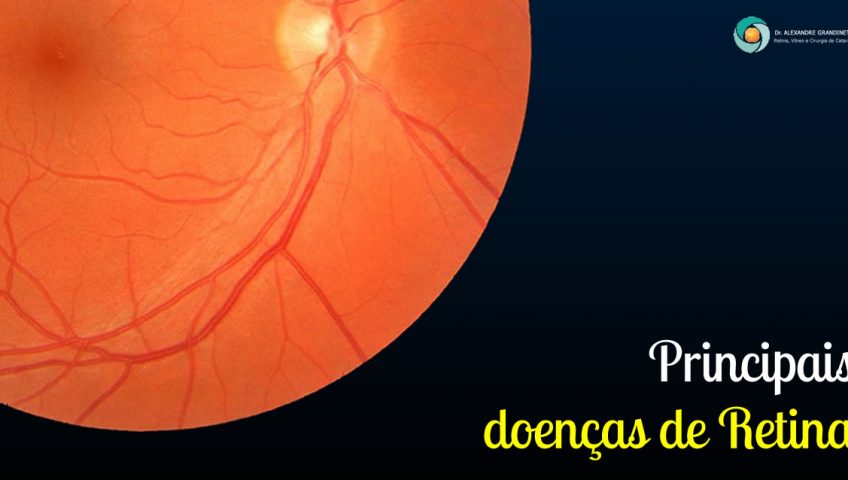 Principais doenças de retina e tratamento em Curitiba