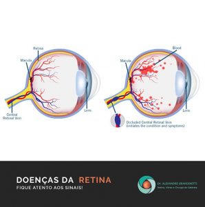 doenças da retina