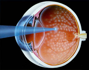 cirurgia de retina a laser em curitiba