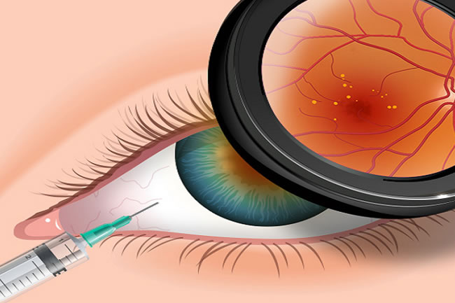 cirurgia de retina em curitiba