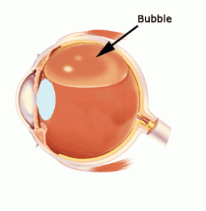 retinopexia pneumática