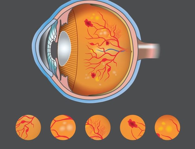 retinopatia diabética curitiba