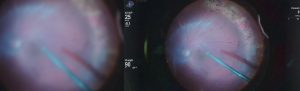 cirurgia de retina curitiba video