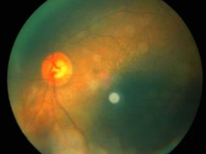 retinopatia diabetica tratamento curitiba