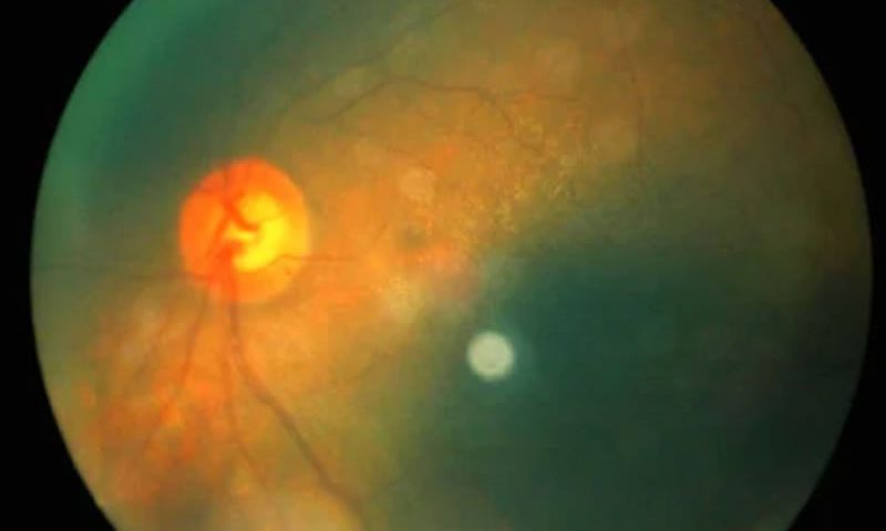 retinopatia diabetica tratamento curitiba