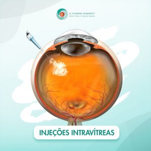 Injeção Intravítrea em Curitiba - O que é, Quais Doenças podem ser Tratadas