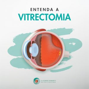 Vitrectomia em Curitiba - Tratamento de Doenças de Retina