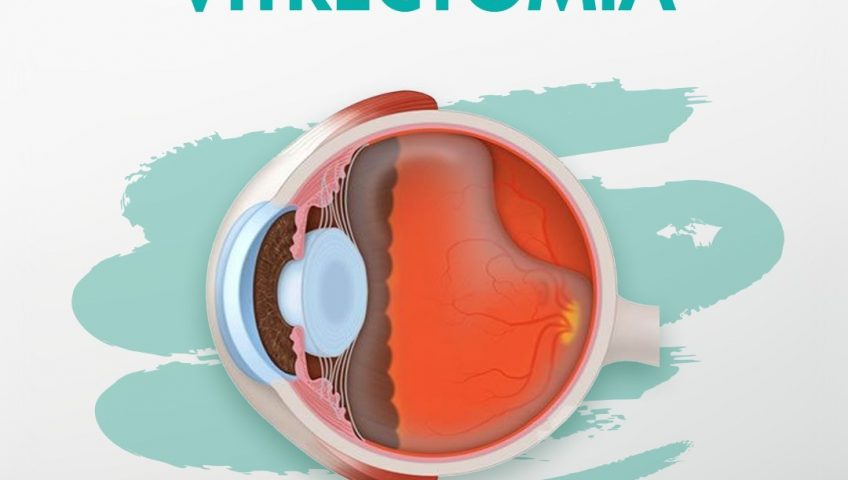 Vitrectomia em Curitiba - Tratamento de Doenças de Retina