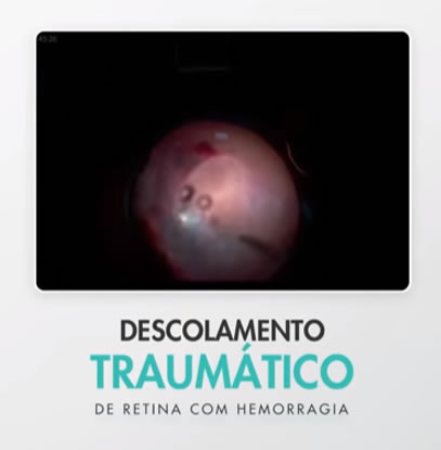 Descolamento Traumático de Retina com Hemorragia Cirurgia em Curitiba