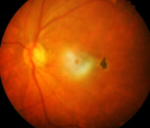 tratamento de descolamento de retina curitiba