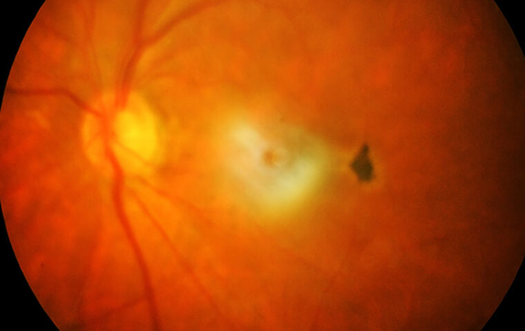 tratamento de descolamento de retina curitiba