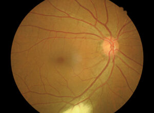 tratamento de descolamento de retina em curitiba
