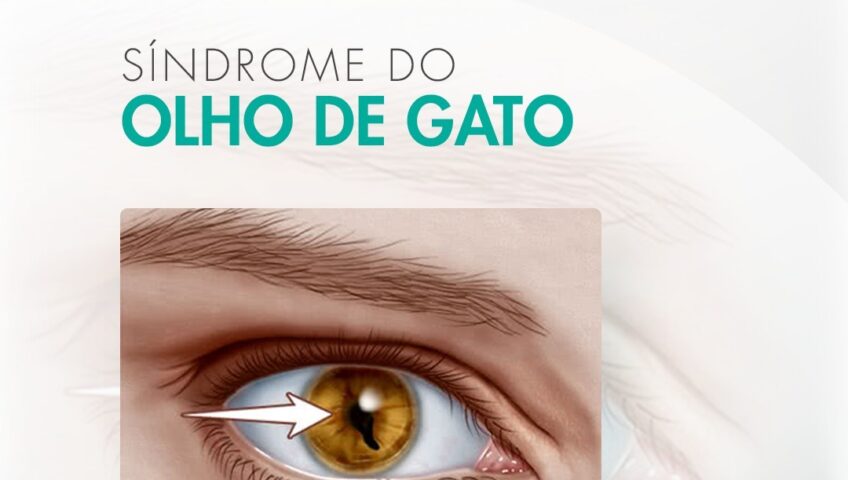 Saiba o que é a Síndrome do Olho de Gato, Causa e Tratamentos