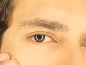 Curitiba Cirurgia de Retina e Catarata com Especialistas