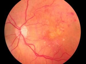 A complexidade da retinopatia diabética um desafio crescente