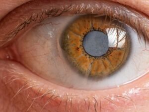 Cirurgia de Catarata Congênita Um Olhar Renovado