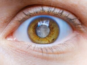 Redescobrindo o Mundo O Impacto da Cirurgia de Catarata Pediátrica