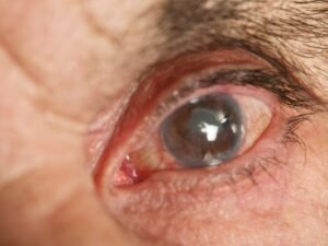 Cirurgia de Catarata em 3D Tecnologia Avançada em Curitiba