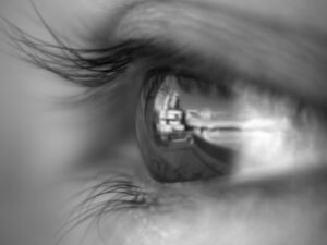 Lentes Intra-Oculares Pós-Cirurgia de Catarata em Curitiba