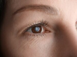 Tratamento da Catarata Congênita com Especialistas em Curitiba