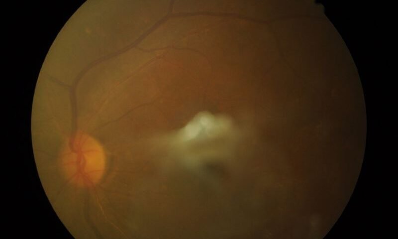 Moscas Volantes e Flashes de Luz em Curitiba Quando isso indica um risco real
