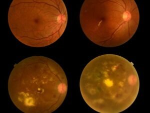 Trauma Ocular e Descolamento de Retina em Curitiba O que fazer em casos de emergência