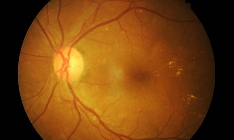 Vitrectomia e Tecnologia 3D O Futuro da Cirurgia de Retina em Curitiba