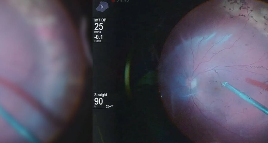 Exame de imagem da retina usado na avaliação de doenças da mácula e do vítreo
