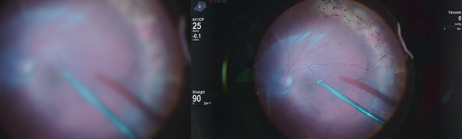 Imagem de retinografia usada na avaliação da retina